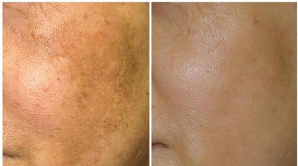 做去老年斑價(jià)格貴不貴