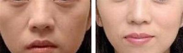 做<a href=http://www.f3bb6.cn/listinfo-768-0.html target=_blank class=infotextkey>微針</a><a href=http://www.f3bb6.cn/listinfo-770-0.html target=_blank class=infotextkey>嫩膚</a>多少錢