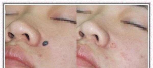 做激光點痣有副作用嗎