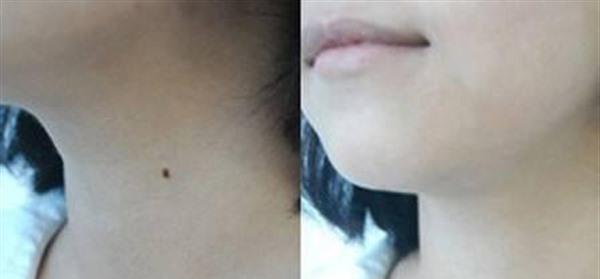 做激光點黑痣手術多少錢？