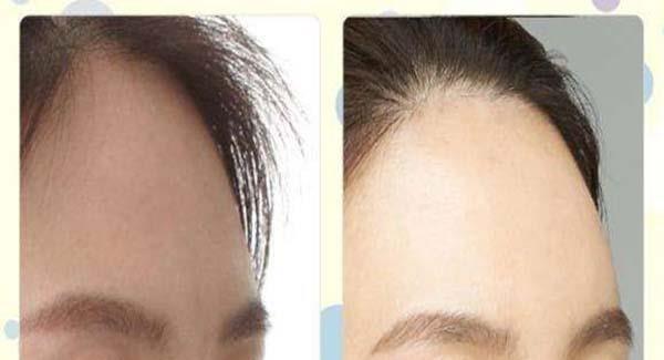 額頭上傷疤怎么辦呢