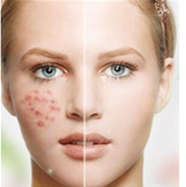 做<a href=http://www.f3bb6.cn/listinfo-613-0.html target=_blank class=infotextkey>射頻</a><a href=http://www.f3bb6.cn/listinfo-768-0.html target=_blank class=infotextkey>微針</a><a href=http://www.f3bb6.cn/listinfo-797-0.html target=_blank class=infotextkey>去痘疤</a>不適應人群有哪些