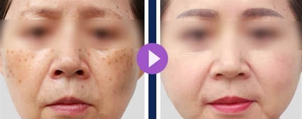 <a href=http://www.f3bb6.cn/listinfo-786-0.html target=_blank class=infotextkey>去黃褐斑</a>的方法