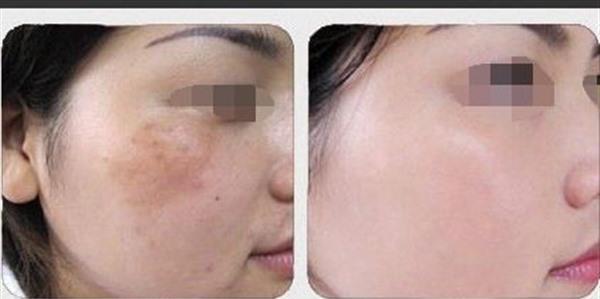 做激光<a href=http://www.f3bb6.cn/listinfo-786-0.html target=_blank class=infotextkey>去黃褐斑</a>副作用是什么