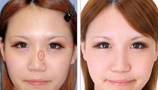 做點痣價格貴不貴