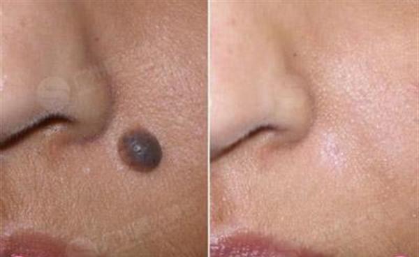 剝脫<a href=http://www.f3bb6.cn/listinfo-788-0.html target=_blank class=infotextkey>去黑痣</a>手術安全嗎？