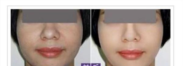 激光美白治療方式是什么？