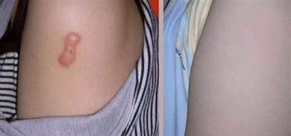 疤痕修復(fù)的方法怎么樣