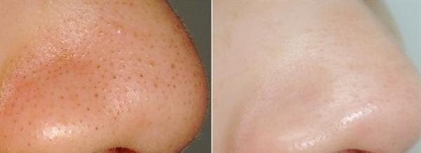 怎樣<a href=http://www.f3bb6.cn/listinfo-769-0.html target=_blank class=infotextkey>去黑頭</a>有用