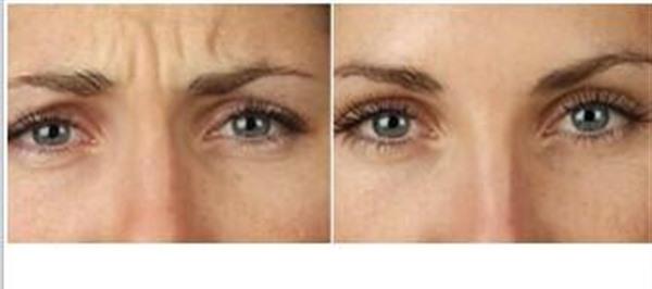 做激光除眉間紋價格貴不貴