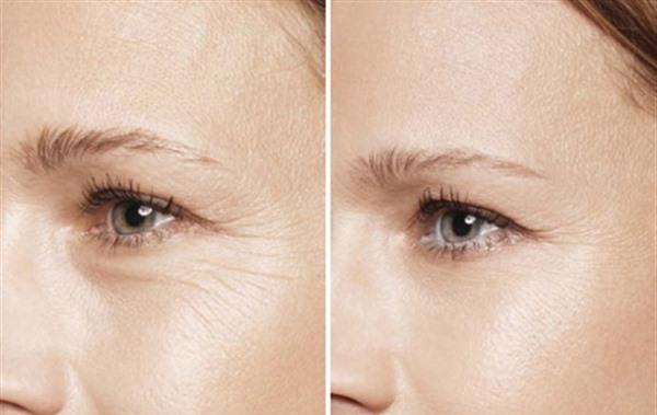 膠原蛋白<a href=http://www.f3bb6.cn/listinfo-780-0.html target=_blank class=infotextkey>去魚尾紋</a>維持時間是多久？