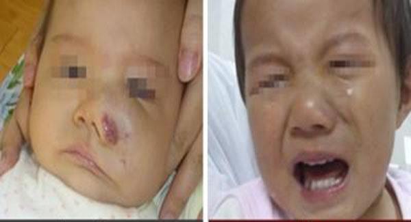 做光子<a href=http://www.f3bb6.cn/listinfo-777-0.html target=_blank class=infotextkey>治療血管瘤</a>副作用