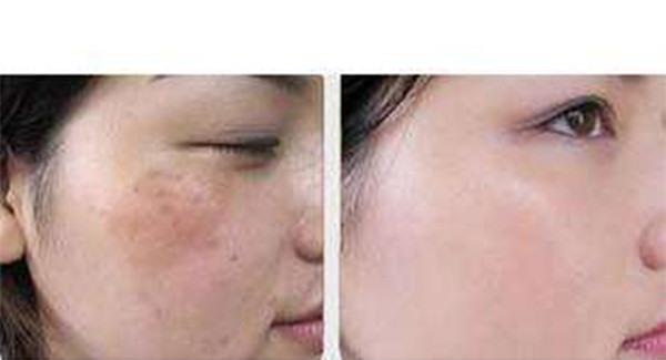 做彩光<a href=http://www.f3bb6.cn/listinfo-795-0.html target=_blank class=infotextkey>祛斑</a>手術注意事項是什么？