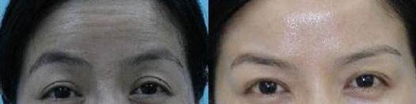 <a href=http://www.f3bb6.cn/listinfo-734-0.html target=_blank class=infotextkey>愛貝芙</a>去除抬頭紋手術缺點有哪些？