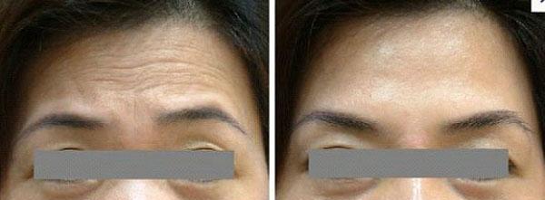 小切口<a href=http://www.f3bb6.cn/listinfo-614-0.html target=_blank class=infotextkey>除皺</a><a href=http://www.f3bb6.cn/listinfo-765-0.html target=_blank class=infotextkey>去抬頭紋</a>手術注意事項是什么?