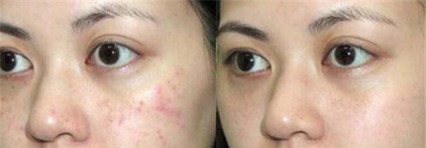 做切除縫合治療痘疤不適應人群有哪些