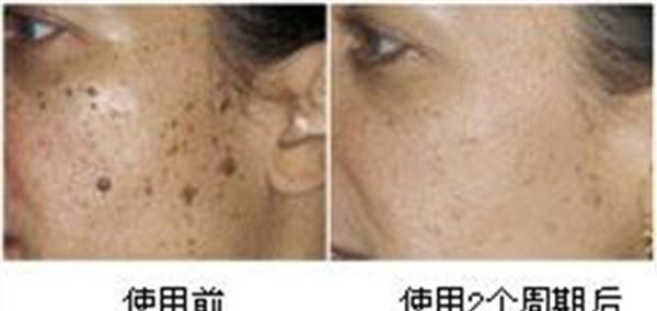 做<a href=http://www.f3bb6.cn/listinfo-788-0.html target=_blank class=infotextkey>去黑痣</a>失敗修復多少錢