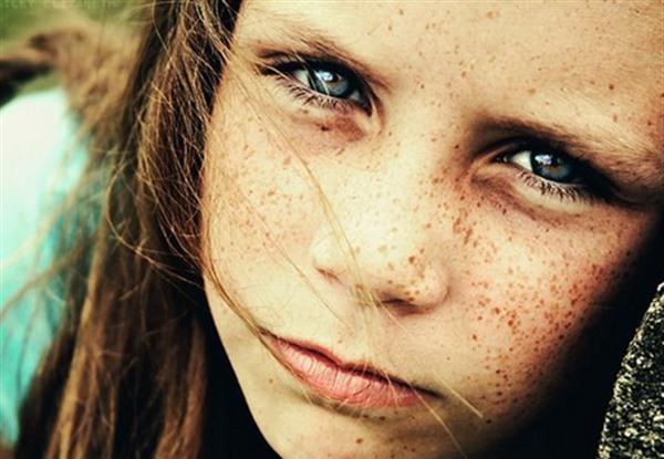 電離子治療<a href=http://www.f3bb6.cn/listinfo-774-0.html target=_blank class=infotextkey>去雀斑</a>適應(yīng)癥狀是什么？