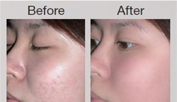 膠原蛋白填充<a href=http://www.f3bb6.cn/listinfo-797-0.html target=_blank class=infotextkey>去痘疤</a>手術效果好不好？