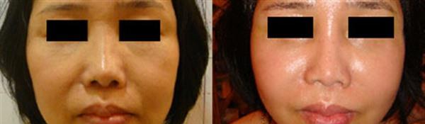 <a href=http://www.f3bb6.cn/listinfo-792-0.html target=_blank class=infotextkey>去法令紋</a>失敗修復手術術后護理？