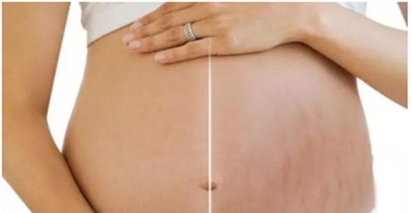 做激光<a href=http://www.f3bb6.cn/listinfo-791-0.html target=_blank class=infotextkey>去妊娠紋</a>不適應人群有哪些