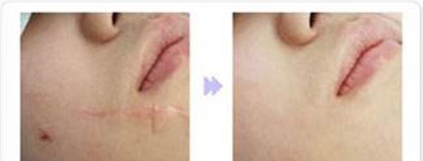 切除縫合治療痘疤手術(shù)術(shù)后護(hù)理？