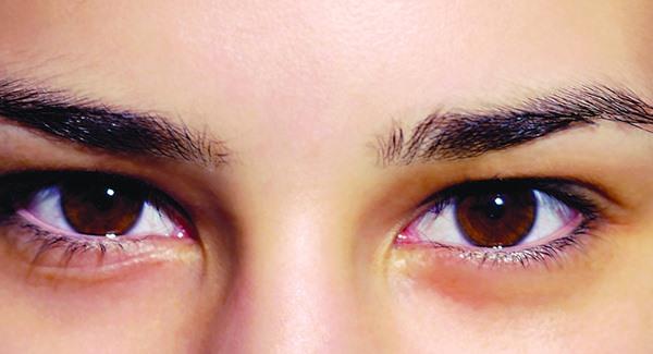 果酸換膚<a href=http://www.f3bb6.cn/listinfo-782-0.html target=_blank class=infotextkey>去眼角細(xì)紋</a>多少錢