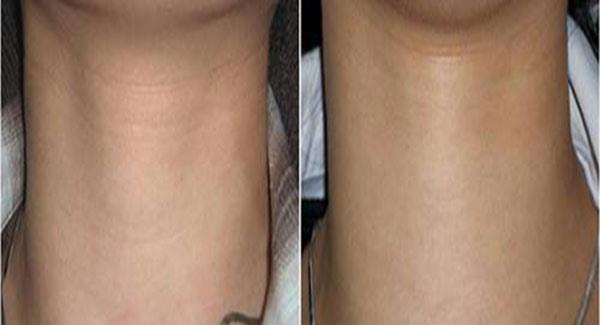 做<a href=http://www.f3bb6.cn/listinfo-731-0.html target=_blank class=infotextkey>玻尿酸</a>除頸紋價格貴嗎