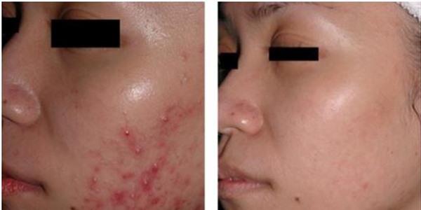 做<a href=http://www.f3bb6.cn/listinfo-779-0.html target=_blank class=infotextkey>治療痤瘡</a>手術多少錢？