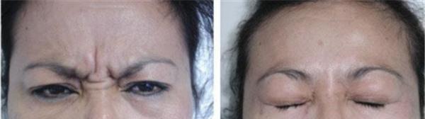 <a href=http://www.f3bb6.cn/listinfo-613-0.html target=_blank class=infotextkey>射頻</a><a href=http://www.f3bb6.cn/listinfo-768-0.html target=_blank class=infotextkey>微針</a><a href=http://www.f3bb6.cn/listinfo-771-0.html target=_blank class=infotextkey>去眉間紋</a>維持時間是多久？