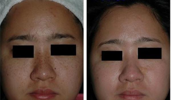 做冷凍法<a href=http://www.f3bb6.cn/listinfo-774-0.html target=_blank class=infotextkey>去雀斑</a>手術多少錢？