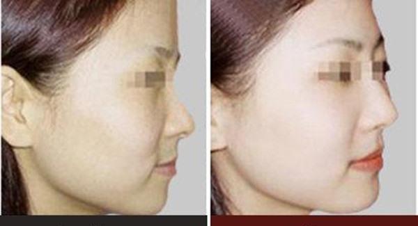 做白瓷娃娃手術時間是多久？