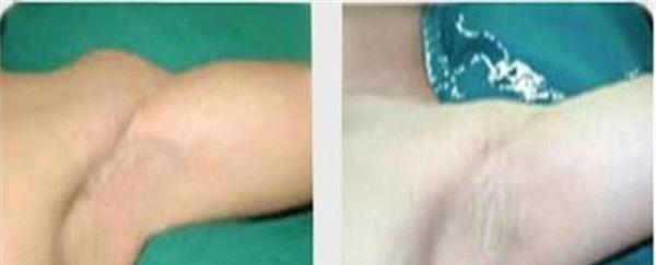 做激光<a href=http://www.f3bb6.cn/listinfo-784-0.html target=_blank class=infotextkey>去狐臭</a>副作用是什么