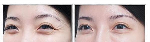 做透明質酸<a href=http://www.f3bb6.cn/listinfo-782-0.html target=_blank class=infotextkey>去眼角細紋</a>手術多少錢？