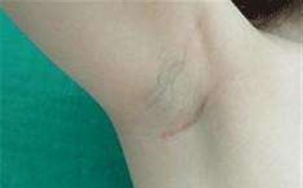 做冷凍法<a href=http://www.f3bb6.cn/listinfo-766-0.html target=_blank class=infotextkey>去腋臭</a>效果怎么樣