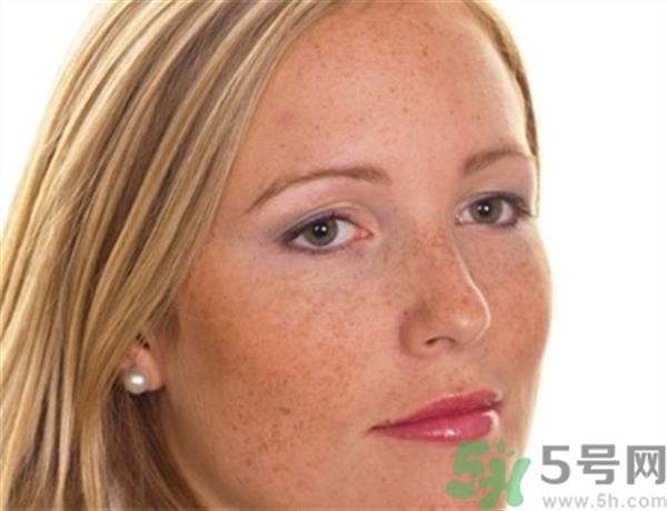 激光<a href=http://www.f3bb6.cn/listinfo-795-0.html target=_blank class=infotextkey>祛斑</a>后反黑怎么辦?激光<a href=http://www.f3bb6.cn/listinfo-795-0.html target=_blank class=infotextkey>祛斑</a>后反黑多久能恢復?