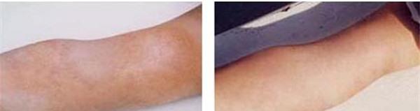 燙傷疤痕修復效果好不好?