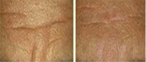 E光除抬頭紋手術(shù)的方法是什么？