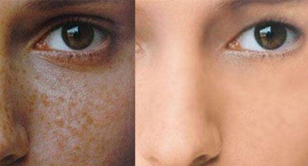 做微晶削磨<a href=http://www.f3bb6.cn/listinfo-795-0.html target=_blank class=infotextkey>祛斑</a>手術注意事項是什么？