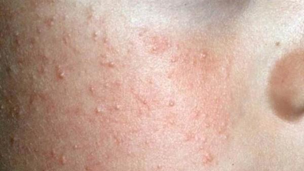 雞皮膚怎么去除？