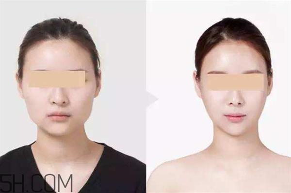 打<a href=http://www.f3bb6.cn/listinfo-631-0.html target=_blank class=infotextkey>瘦臉</a><a href=http://www.f3bb6.cn/listinfo-614-0.html target=_blank class=infotextkey>除皺</a>可以抽煙嗎？打<a href=http://www.f3bb6.cn/listinfo-631-0.html target=_blank class=infotextkey>瘦臉</a><a href=http://www.f3bb6.cn/listinfo-614-0.html target=_blank class=infotextkey>除皺</a>會反彈嗎？