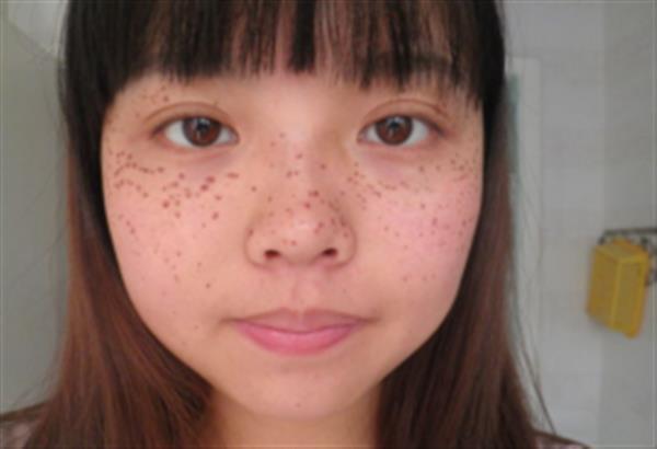 激光治療黃褐斑怎么樣