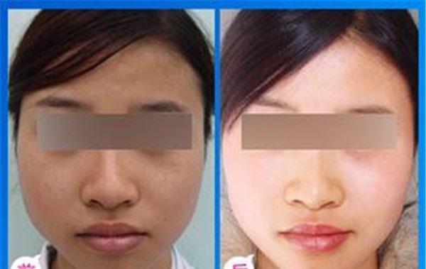 激光美白適合什么人？