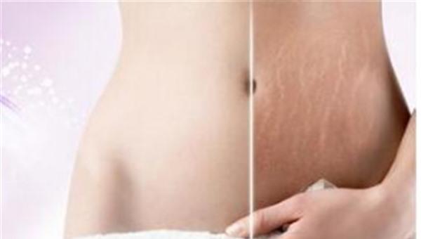 做微晶<a href=http://www.f3bb6.cn/listinfo-791-0.html target=_blank class=infotextkey>去妊娠紋</a>不適應(yīng)人群有哪些