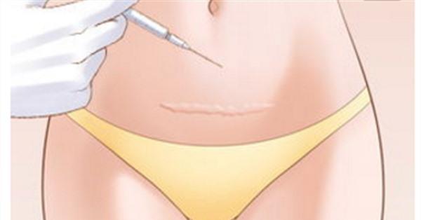 疤痕修復的危害有哪些