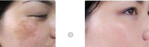 長斑的原因及<a href=http://www.f3bb6.cn/listinfo-795-0.html target=_blank class=infotextkey>祛斑</a>的方法。