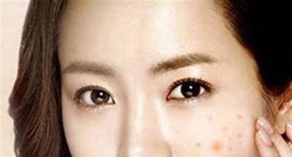 有哪些方法能夠祛痘