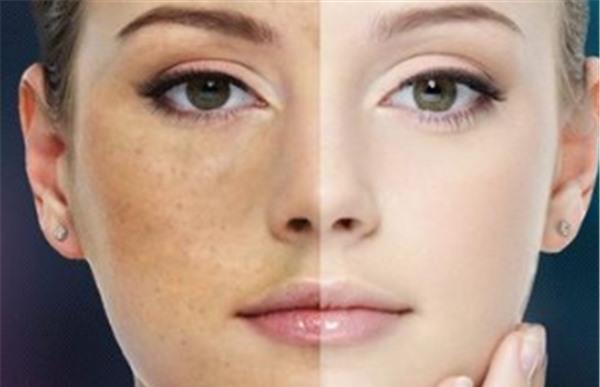 做光子美白不適應(yīng)人群有哪些