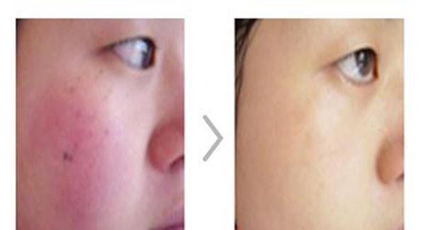 做激光祛紅血絲價(jià)格多少錢