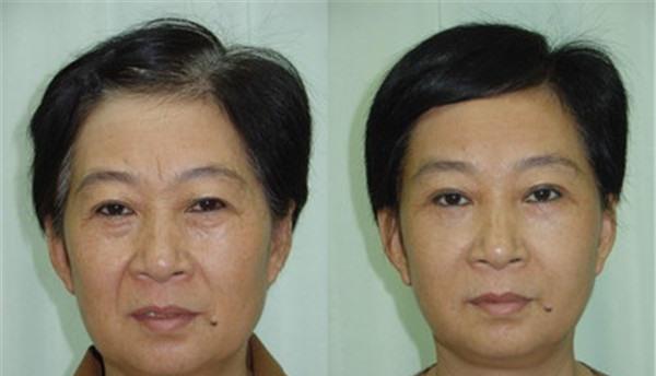 做E光<a href=http://www.f3bb6.cn/listinfo-792-0.html target=_blank class=infotextkey>去法令紋</a>價格